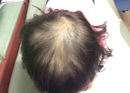 Why does thyroid medicine cause hair loss?